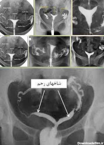 عکس رنگی لوله های رحم