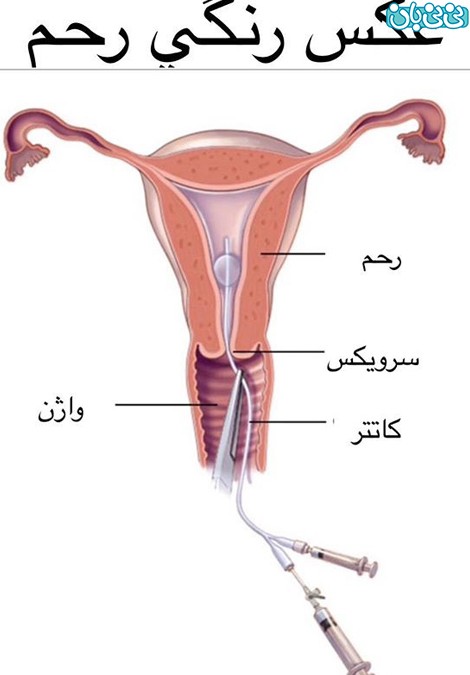 عکس رنگی از رحم بدون درد