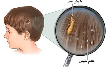 عکس موی پر از شپش