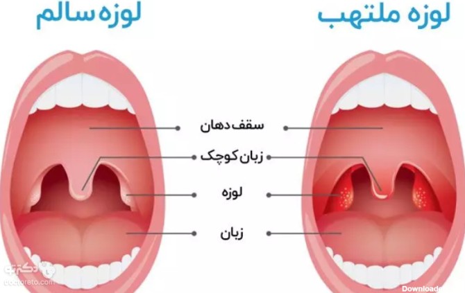 عکس لوزه سالم در کودکان