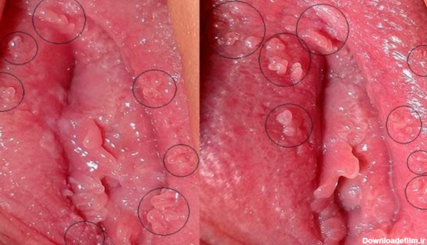 عکس زگیل تناسلی در لابیا