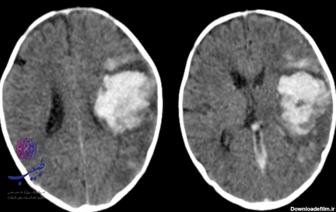 عکس انواع خونریزی مغزی