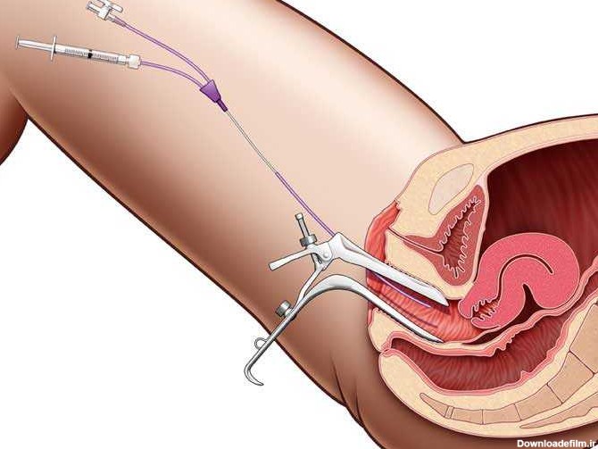 عوارض عکس رنگی از لوله های رحم