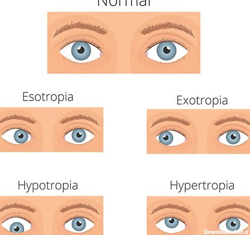 عکس انحراف چشم به داخل