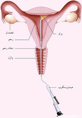 عکس رنگی رحم نی نی