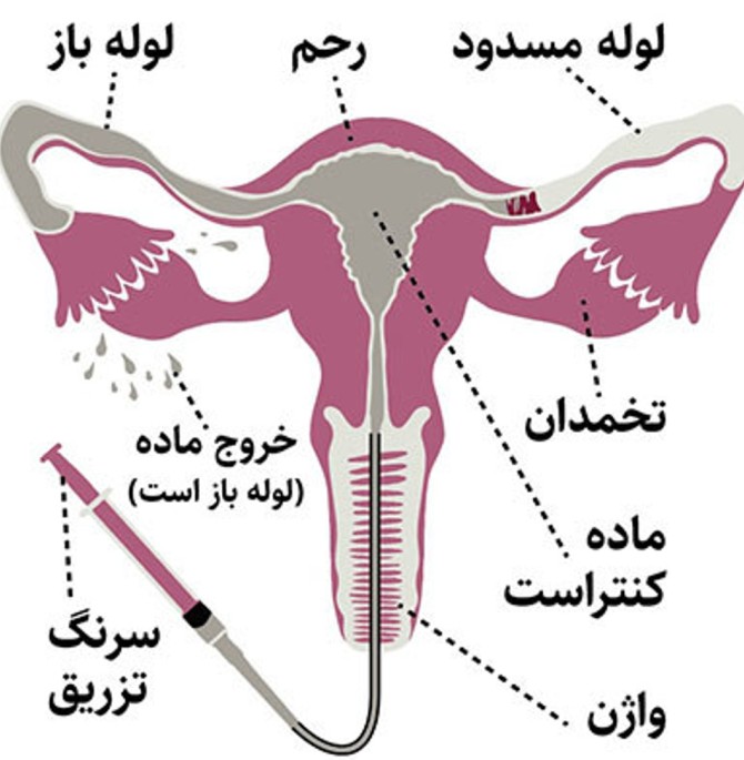 نحوه گرفتن عکس رنگی رحم