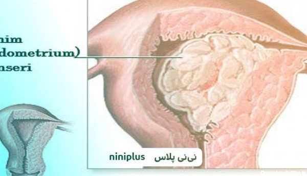 ضخامت آندومتر عکس ضخیم شدن دیواره رحم