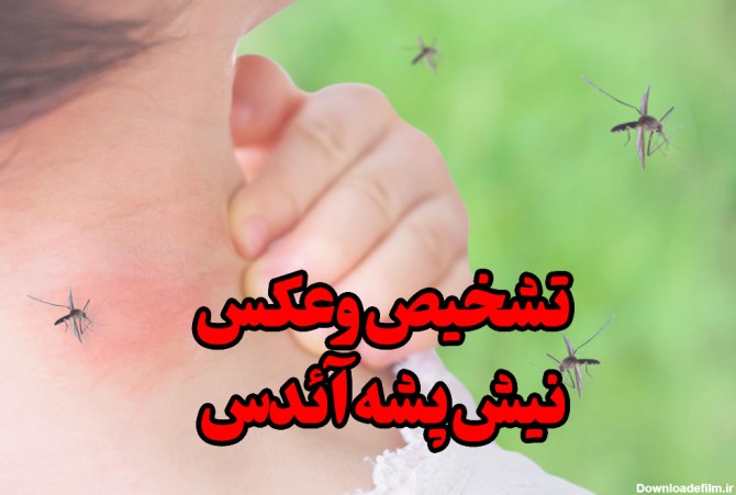 عکس جای نیش پشه آئدس