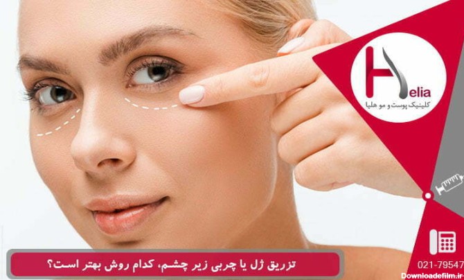 عکس تزریق ژل برای گودی زیر چشم