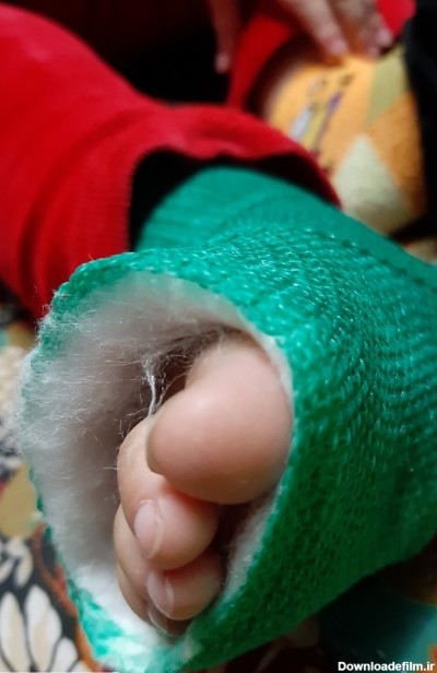 عکس پروفایل پای شکسته دختر