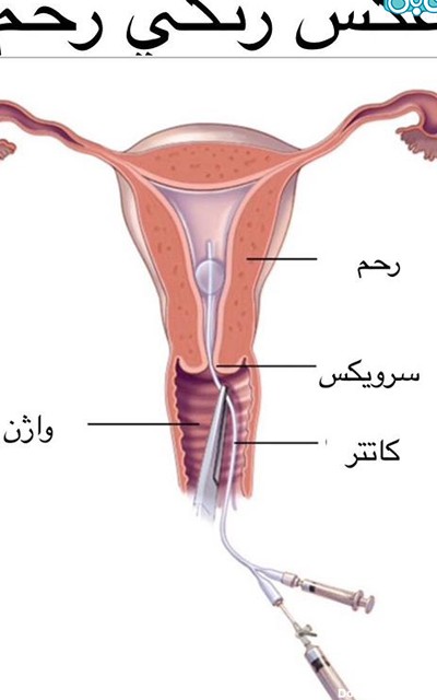 طریقه گرفتن عکس رنگی از رحم