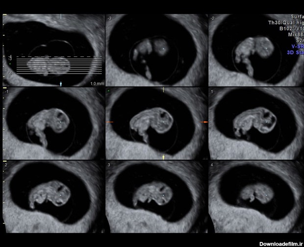 عکس جنین سه ماهه دختر