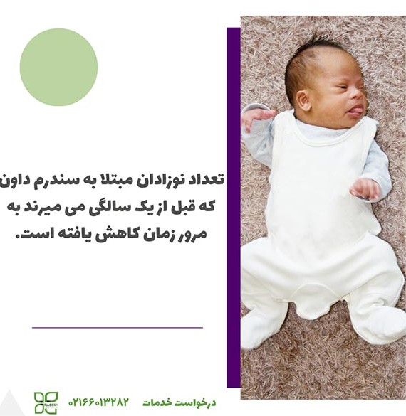 عکس نوزاد سندرم داون