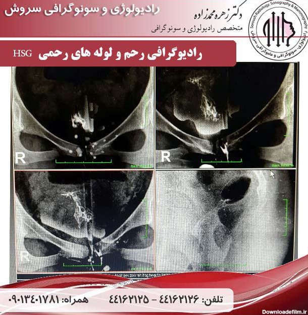 عکس رنگی از رحم و لوله