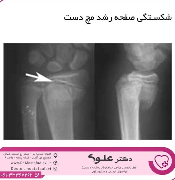 عکس مچ دست برای قد