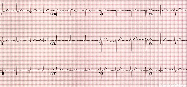 عکس ضربان قلب طبیعی