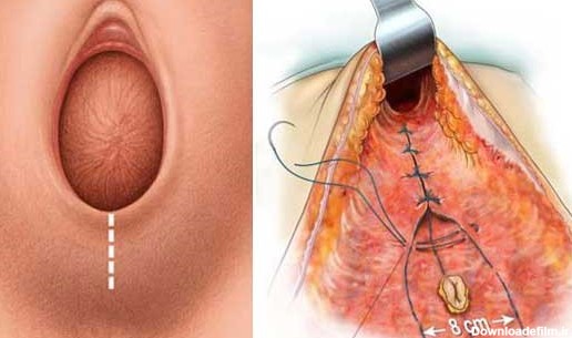 عکس بخیه زایمان طبیعی باز شده