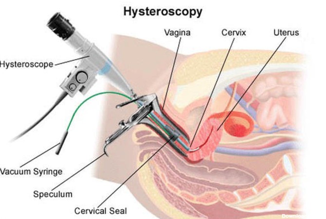 عکس داخل لوله رحم