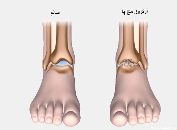 عکس از مچ پای سالم