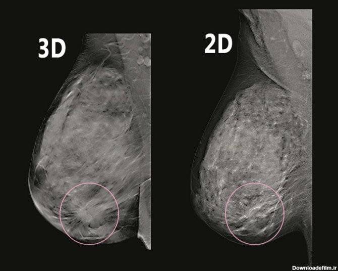 میکروکلسیفیکاسیون عکس ماموگرافی سرطانی