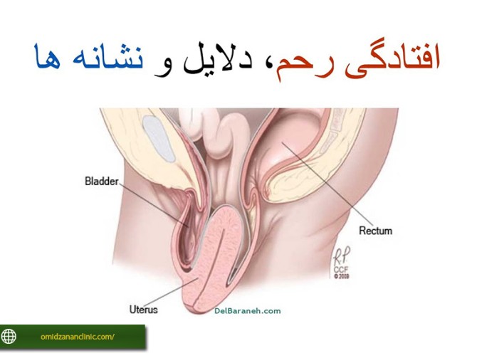 عکس افتادگی رحم زنان