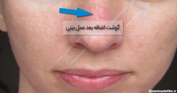 عکس گوشت اضافه داخل بینی