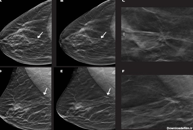 عکس ماموگرافی نرمال