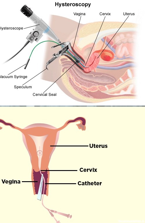 عکس رنگی رحم با بی حسی موضعی