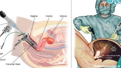 اقدام به بارداری بعد از عکس رنگی رحم