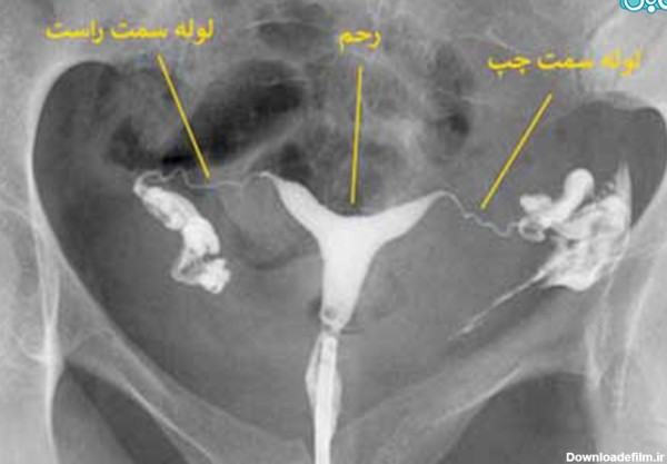 عکس رنگی رحم و اقدام بارداری