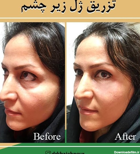 عکس تزریق ژل زیر چشم