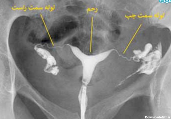 عکس رنگی رحم با بی حسی چگونه است