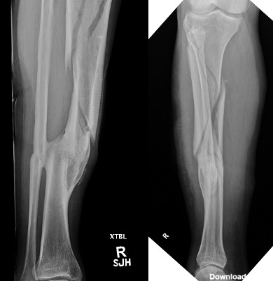 عکس استخوان جوش خورده ساق پا