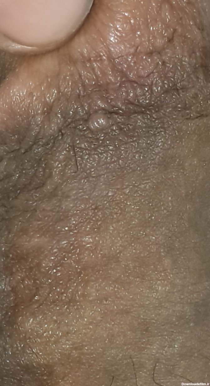 عکس زگیل تناسلی روی لابیا