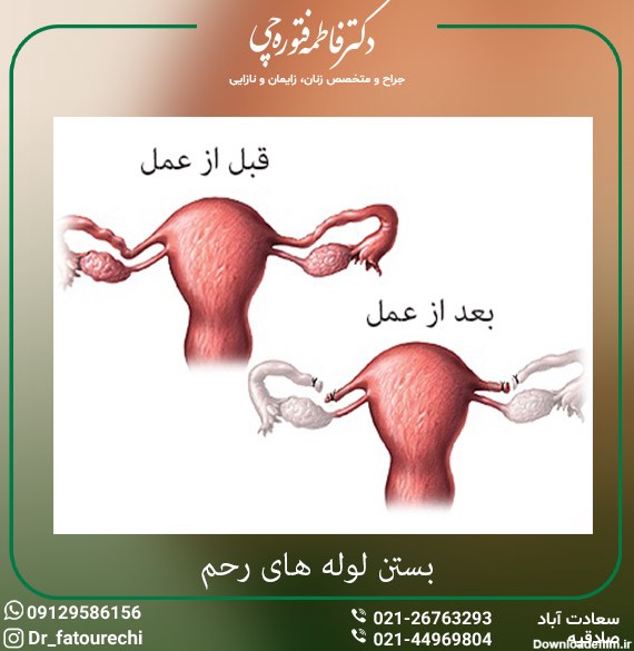 عکس لوله رحم زنان