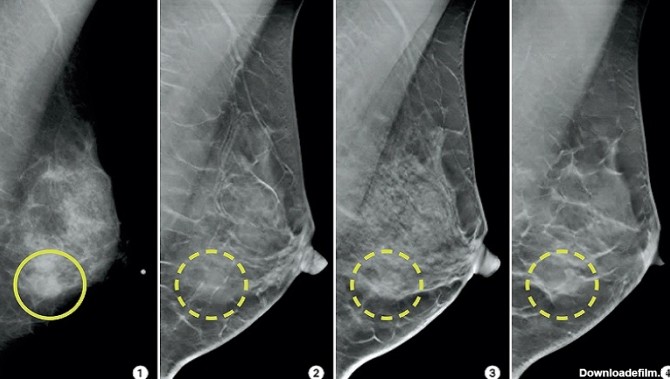 عکس ماموگرافی چیست