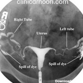 عکس رنگی از لوله های رحمی