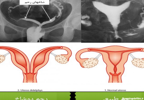 عکس رنگی از لوله های رحم درد دارد